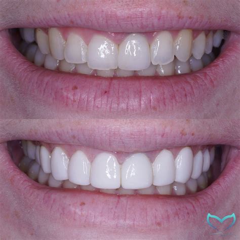 Composite Veneers: What You Need To Know – .